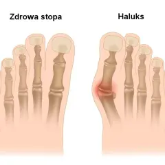 Ból haluksa: dlaczego stopa cierpi i jak znaleźć ulgę?