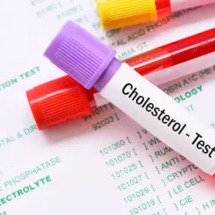 Probówki z krwią na tle dokumentu z badaniami. Jedna probówka ma etykietę "Cholesterol - Test". To pokazuje, lipidogram co to jest.