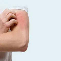 Un bras rouge et irrité se gratte, une sensation de chatouillement sur la peau qui devient insupportable.