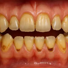 Denti ingialliti e con evidenti segni di **denti corrosi** alla base, che necessitano di cure.