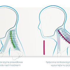 Prawidłowa lordoza szyjna z brodą nad mostkiem vs. spłycona lordoza szyjna z wysuniętą głową. Ilustracja pokazuje zniesienie lordozy szyjnej.