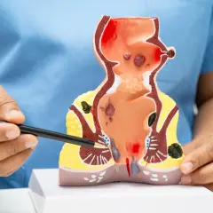 Modello anatomico che illustra emorroidi sanguinanti e altre patologie anali.