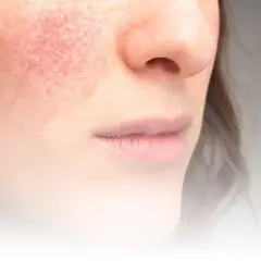 Närbild på en kvinna med rodnad på kinden, ett tecken på rosacea. Bilden visar hur man kan behandla rosacea.