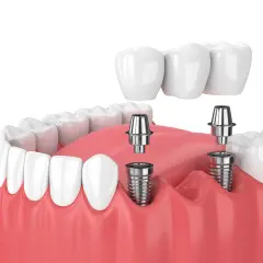 Model szczęki z widocznymi implantami zębowymi i mostem protetycznym. Implant zęba to nowoczesne rozwiązanie.