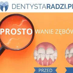Licówki na krzywe zęby: przed i po. Lupa pokazuje "PROSTO", a obok dwa uśmiechy - jeden z nierównymi zębami, drugi idealny.