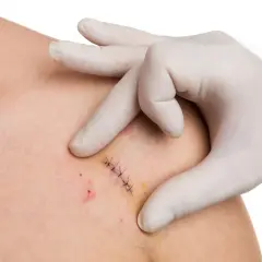 Main d'un professionnel en gant blanc examinant une plaie suturée, préparant l'ablation des points de suture.