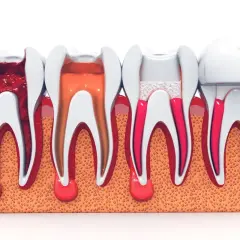 Ilustración de dientes con pulpectomia multirradicular, mostrando diferentes etapas de tratamiento endodóntico.
