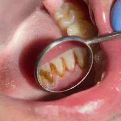 Widok zęba w lusterku dentystycznym, pokrytego żółto-brązowym kamieniem nazębnym. Czy kamień nazębny śmierdzi? Tak, może powodować nieświeży oddech.