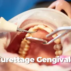 Dettaglio di una pulizia sottogengivale con strumento a ultrasuoni e specchietto dentale.