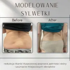 Liposukcja: co to? Modelowanie sylwetki, metody, ceny ekspert radzi