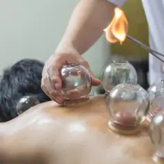 Terapeuta stosuje bańki na plecy pacjenta, podgrzewając je ogniem.