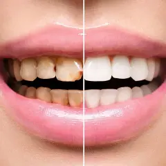 Sorriso diviso: da denti ingialliti e con placca a bianchi e splendenti.