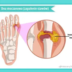 Dna moczanowa, zwana chorobą królów, to zapalenie stawów spowodowane kryształami kwasu moczowego w paluchu.