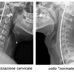 Radiografie del rachide cervicale: a sinistra, rettilineizzazione cervicale con frecce che indicano anomalie; a destra, collo "normale".