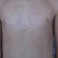 Torace con lesioni cutanee rosse e pruriginose, indicative di pitiriasi lichenoide cronica.