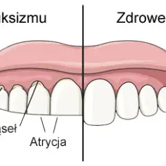 Co oznacza zgrzytanie zębami przez sen i jak temu zapobiec