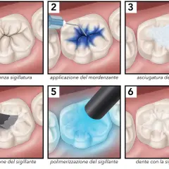 Illustrazione dei passaggi per sigillare i solchi dei denti, dalla preparazione all'applicazione del sigillante.