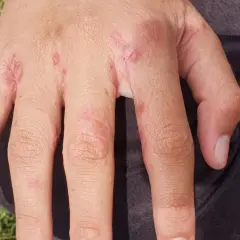 Här ser du hur skabb utslag kan se ut på händerna: små röda prickar och irriterad hud mellan fingrarna.