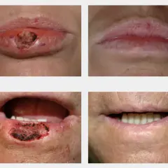 Cuatro imágenes muestran la evolución de un bulto en el labio, desde una lesión hasta la curación.