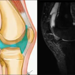 Zgrubienie pod kolanem, czyli torbiel Bakera, widoczne na rysunku anatomicznym i obrazie rezonansu magnetycznego.