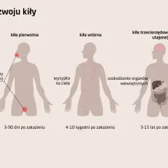 Ilustracja przedstawia stadia rozwoju kiły: pierwotna (wrzód), wtórna (wysypka) i trzeciorzędowa (uszkodzenie organów).