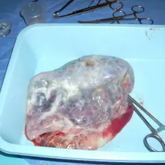 Här ser du hur en moderkaka kan se ut. Den är fuktig, oregelbunden och har en mörkrödaktig ton med vita inslag.