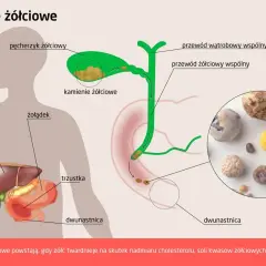 Nerwica woreczka żółciowego: jak rozpoznać i leczyć ból?