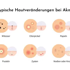 Illustration zeigt typische Hautveränderungen bei Akne: Mitesser, Eiterpickel, Papeln, Pusteln, Zysten und Knoten.