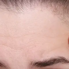 Primer plano de una frente con arrugas finas y una ceja poblada, casi una uniceja. Un dedo toca suavemente la piel.