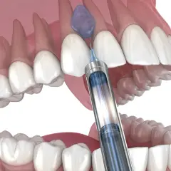 Jak długo działa znieczulenie u dentysty? Sprawdź, kiedy wróci czucie!