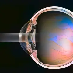 Przekrój oka po zabiegu laserowym usuwającym zaćmę wtórną. Zalecenia po zabiegu obejmują ochronę oczu.