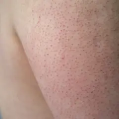 Närbild på hud med små röda prickar, typiskt för keratosis pilaris hos barn.