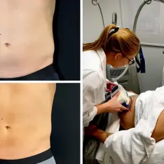 Före- och efterbilder på en mage som behandlats med fett frysning. En kvinna utför behandlingen på en liggande man.