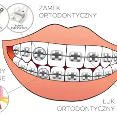 Kiedy założyć aparat na zęby? Wiek, warunki i proces krok po kroku
