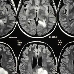 Czy rezonans magnetyczny wykryje chorobę psychiczną? Oto prawda