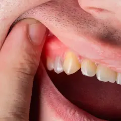 Gengiva arrossata e gonfia vicino a un dente, sintomo di un ascesso dentale. Quanto dura? Dipende dalla cura.
