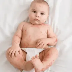 Bambino con eruzione cutanea rossa su tutto il corpo, possibile sudamina bambini.