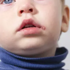 Czy dziecko z opryszczką może iść do szkoły? Ważne informacje dla rodziców