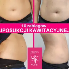 Ile zabiegów liposukcji kawitacyjnej? Odkryj swój plan!