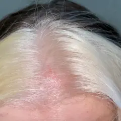 Cuero cabelludo enrojecido y con irritación, con mechones de cabello oscuro y rubio. Busca cómo curar quemaduras en el cuero cabelludo por decoloración.