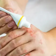Maść po terminie: groźne skutki! Jak postępować bezpiecznie?