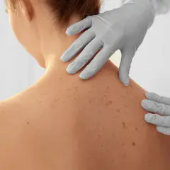Dermatolog w rękawiczkach bada pieprzyki na plecach pacjentki.