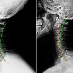 Radiografie cervicali che mostrano una lordosi cervicale ridotta, potenziale causa di vertigini.