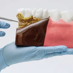 Model szczęki z widocznym kamieniem nazębnym i chorobą dziąseł. Ręka w rękawiczce trzyma narzędzie dentystyczne.