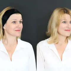 Kobieta przed i po zabiegu, z opaską na włosach i bez. Widać subtelne karisma efekty.