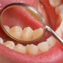Widok jamy ustnej z lusterkiem dentystycznym. Na zębach widoczne są żółtawe przebarwienia, które mogą być początkiem próchnicy lub osadu.