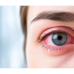 Occhio rosso e irritato, con lacrime che scendono. I congiuntivite sintomi sono evidenti.
