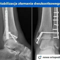Złamana kość? Ile trwa rehabilitacja i jak wrócić do formy?