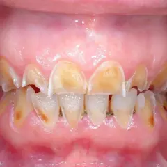 Denti ingialliti e consumati, con smalto eroso, un segno visibile degli effetti dell'anoressia sulla salute orale.