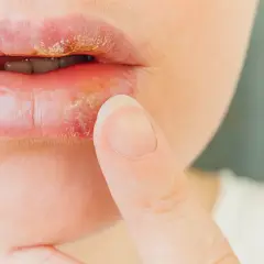 Labios con herpes labial, mostrando costras amarillentas y enrojecimiento. Un dedo se acerca a la zona afectada.